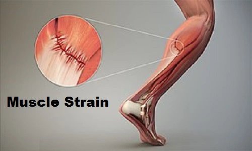 Muscle Strain