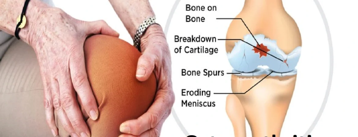 Osteoarthritis Pain Cause, Symptoms, Risk, Diagnosis & Treatment
