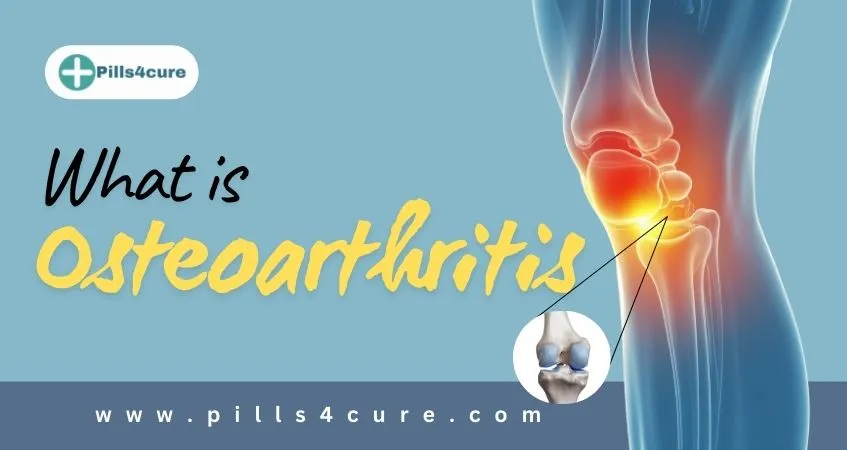 Osteoarthritis Pain Cause, Symptoms, Risk, Diagnosis & Treatment