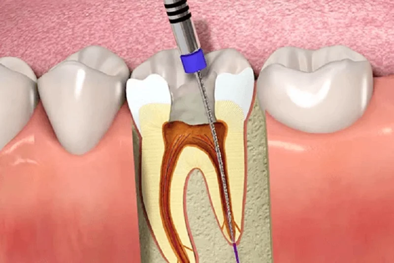 Root Canal Procedure