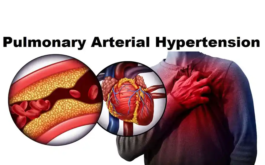 PAH – Types, Causes