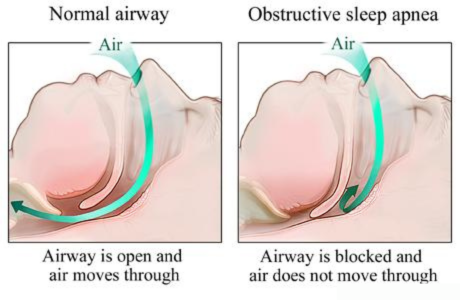 Sleep Apnea: Causes, Symptoms, Treatment, and Natural Remedies 1 sleep apnea