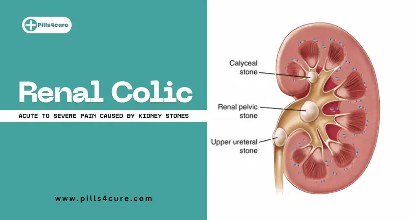 Renal Colic: Symptoms, Causes, Diagnosis, and Treatment